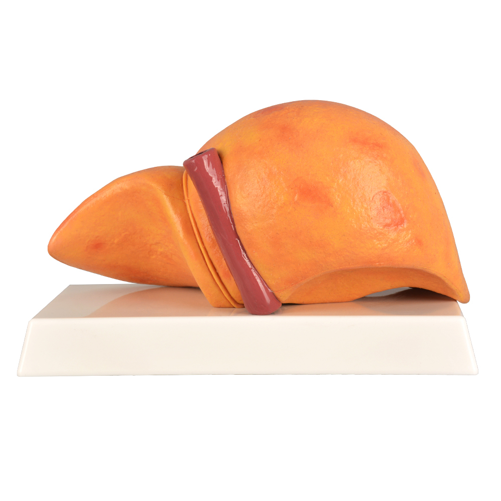 Human Pathological Liver Model with Alcoholic Liver Disease, Silicone