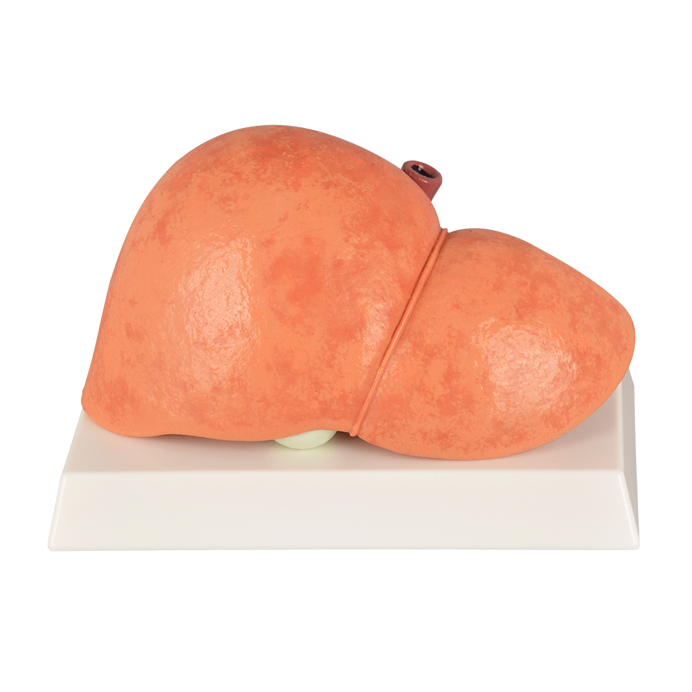 Silicone Liver Simulation Model with Non-Alcoholic Fatty Liver Disease