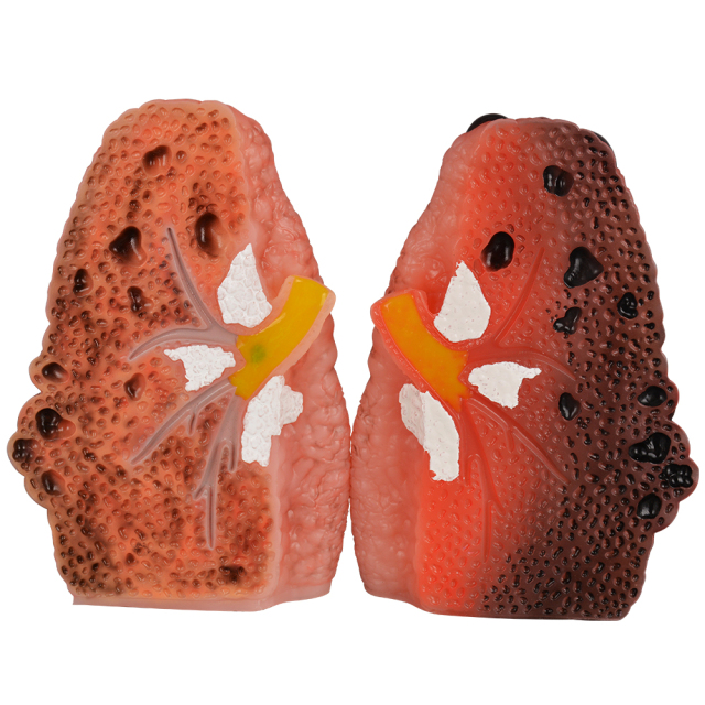 Cough Up Lung Model