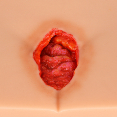 Silicone Pressure Ulcer (Stage 1-4) Demonstration and Care Model