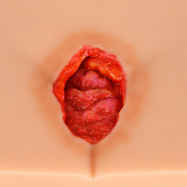 Silicone Pressure Ulcer (Stage 1-4) Demonstration and Care Model