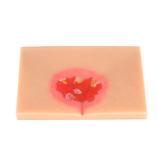 Silicone Pressure Ulcer (Stage 1-4) Demonstration and Care Model