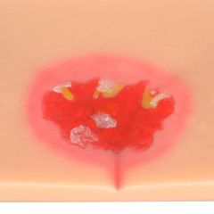 Silicone Pressure Ulcer (Stage 1-4) Demonstration and Care Model