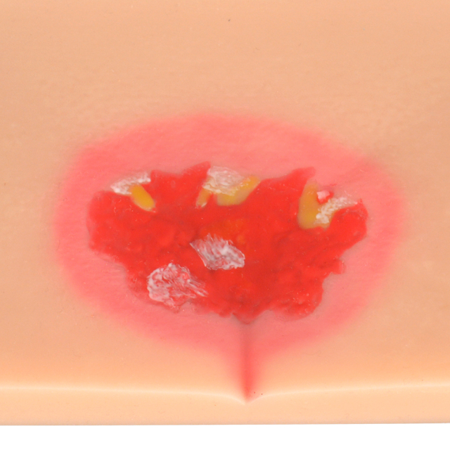 Silicone Pressure Ulcer (Stage 1-4) Demonstration and Care Model