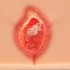 Silicone Pressure Ulcer (Stage 1-4) Demonstration and Care Model