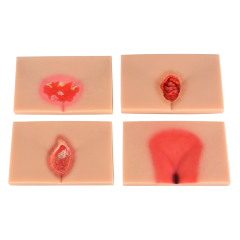 Silicone Pressure Ulcer (Stage 1-4) Demonstration and Care Model