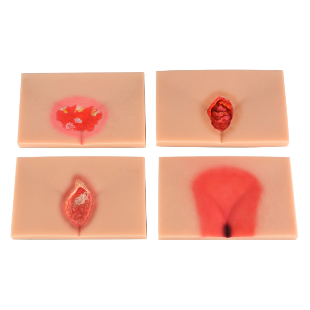 Silicone Pressure Ulcer (Stage 1-4) Demonstration and Care Model