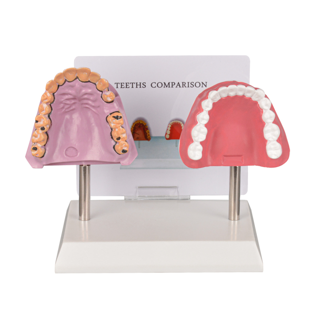 Healthy vs Smoker’s Oral Health Education Model