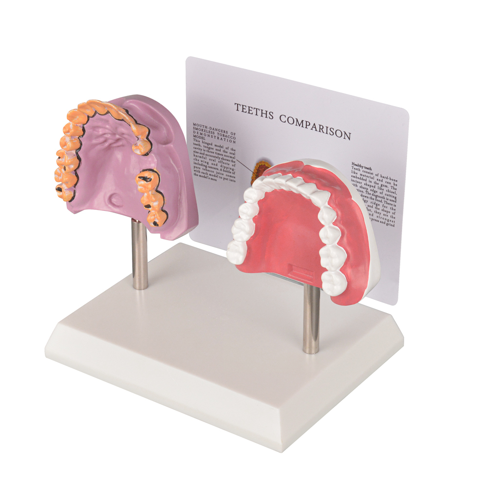 Healthy vs Smoker’s Oral Health Education Model