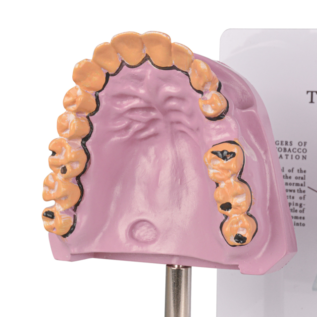 Healthy vs Smoker’s Oral Health Education Model