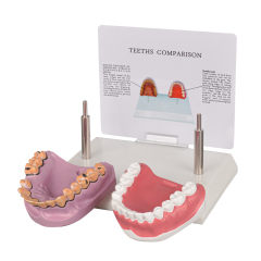 Healthy vs Smoker’s Oral Health Education Model