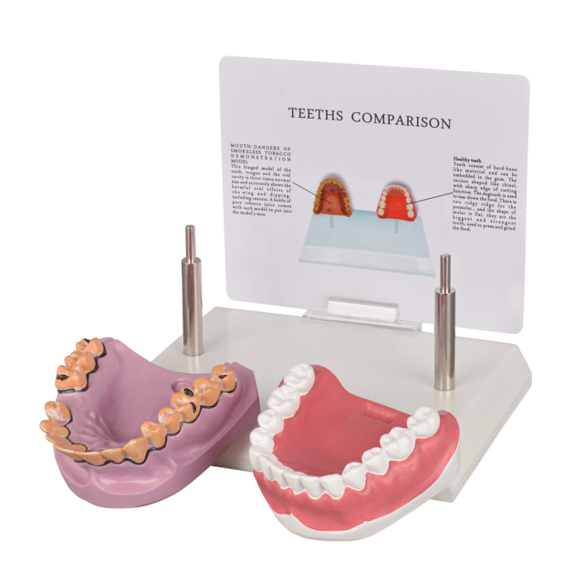 Healthy vs Smoker’s Oral Health Education Model
