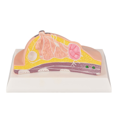Anatomy Breast Model with Common Diseases