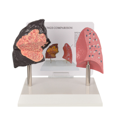 Healthy vs Smoker Lung Model
