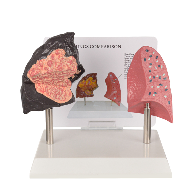 Healthy vs Smoker Lung Model