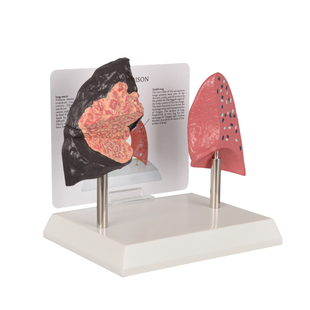 Healthy vs Smoker Lung Model