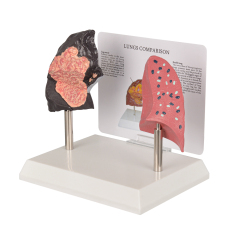 Healthy vs Smoker Lung Model