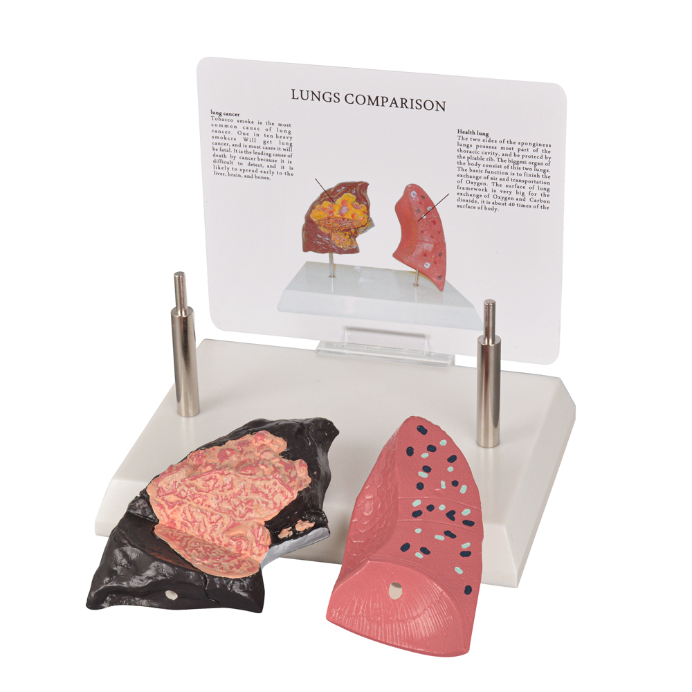 Healthy vs Smoker Lung Model