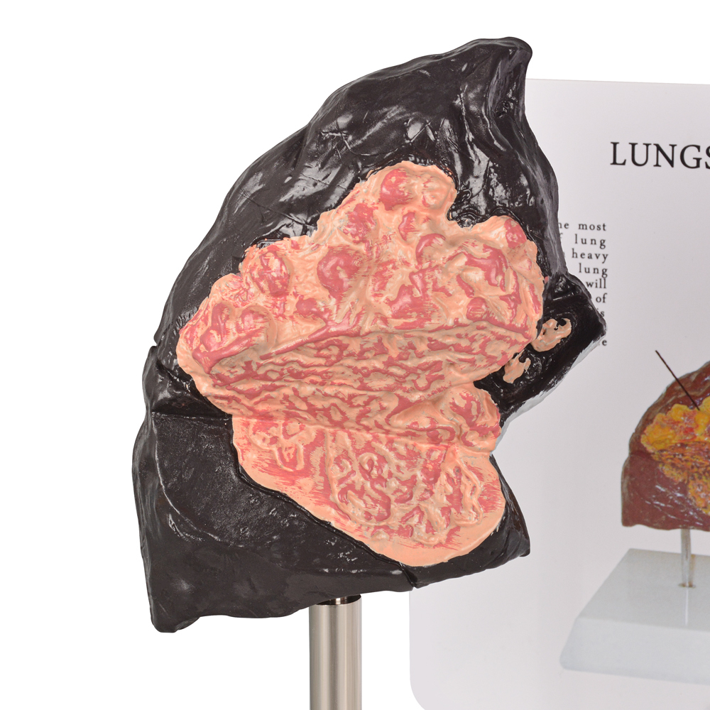 Healthy vs Smoker Lung Model