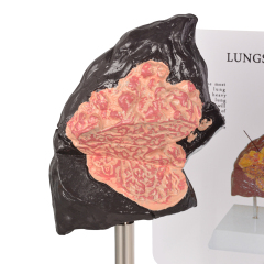 Healthy vs Smoker Lung Model