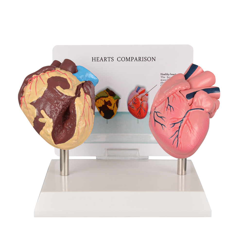 Healthy vs Smoker Heart Model