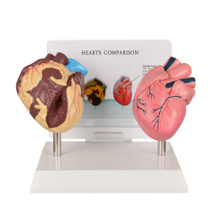 Healthy vs Smoker Heart Model
