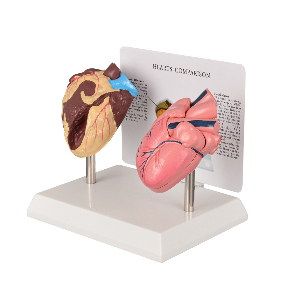 Healthy vs Smoker Heart Model