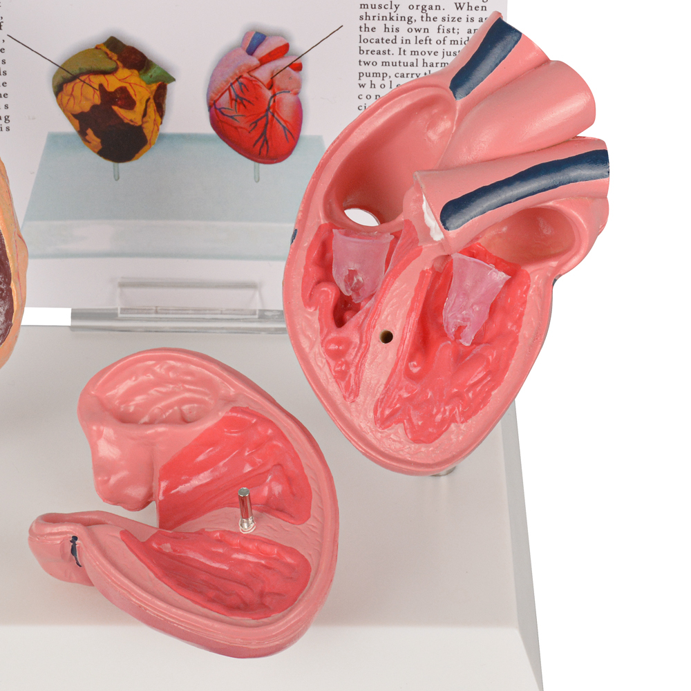 Healthy vs Smoker Heart Model