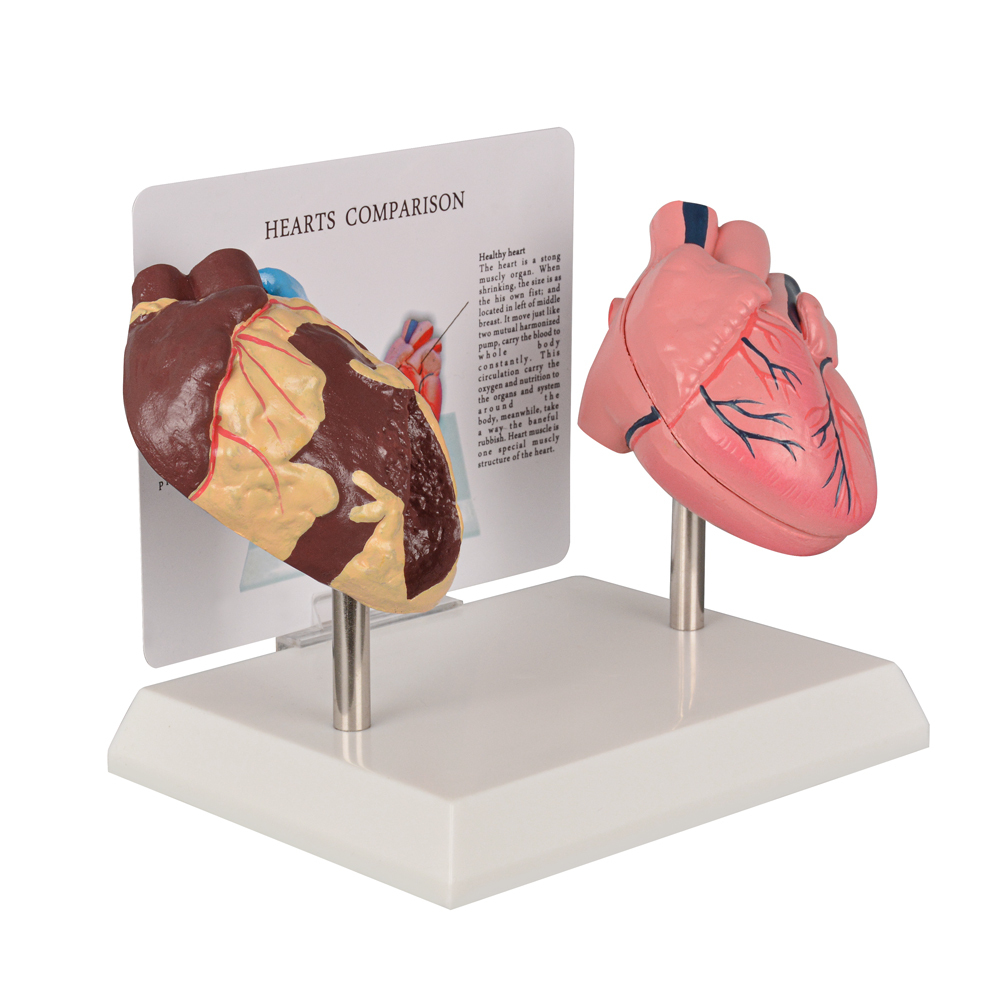 Healthy vs Smoker Heart Model