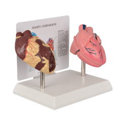 Healthy vs Smoker Heart Model