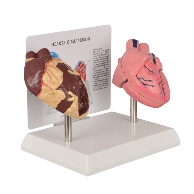 Healthy vs Smoker Heart Model