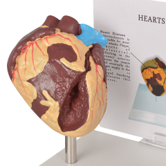 Healthy vs Smoker Heart Model