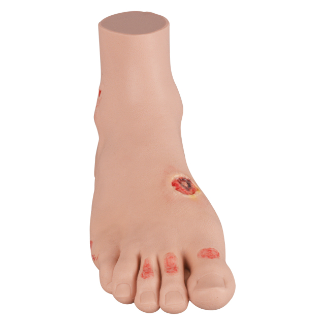 Mild Diabetic Foot Model