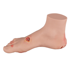 Mild Diabetic Foot Model