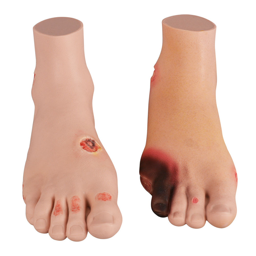 Severe Diabetic Foot Model