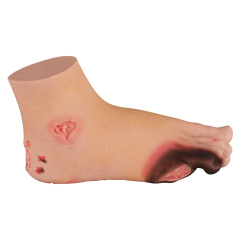 Severe Diabetic Foot Model