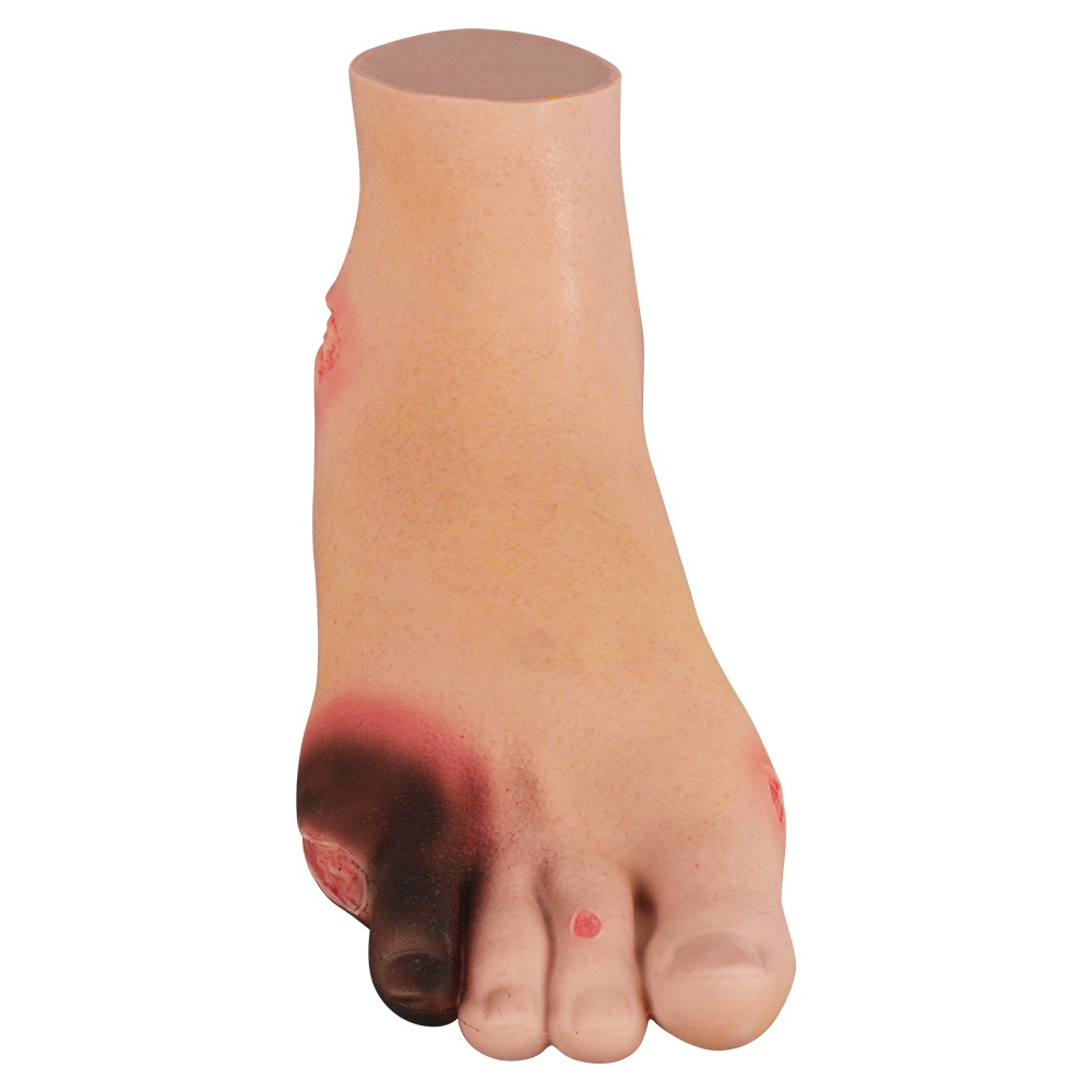Severe Diabetic Foot Model