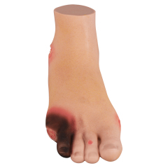 Severe Diabetic Foot Model