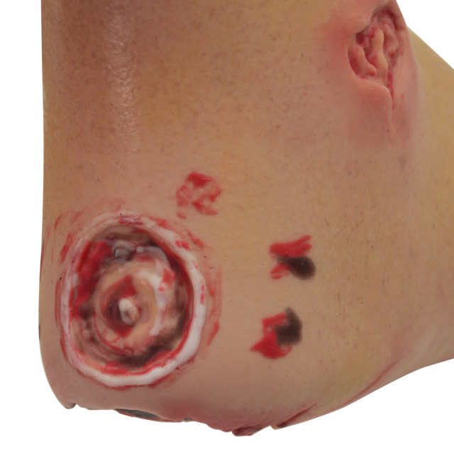 Severe Diabetic Foot Model
