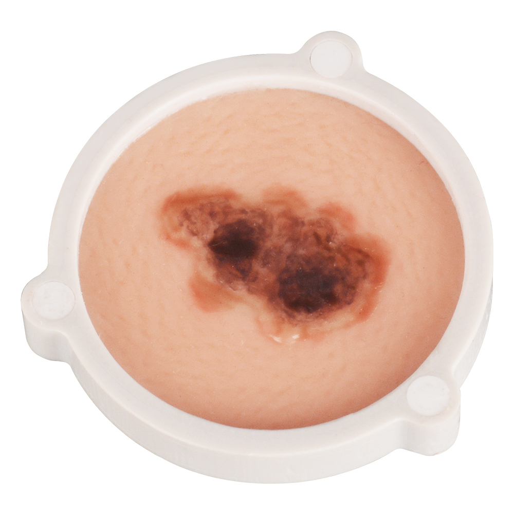 Silicone Skin Cancer Model
