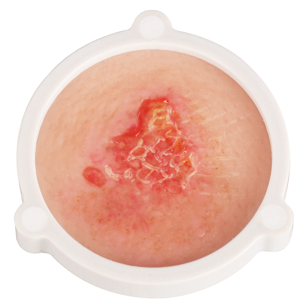Silicone Skin Cancer Model