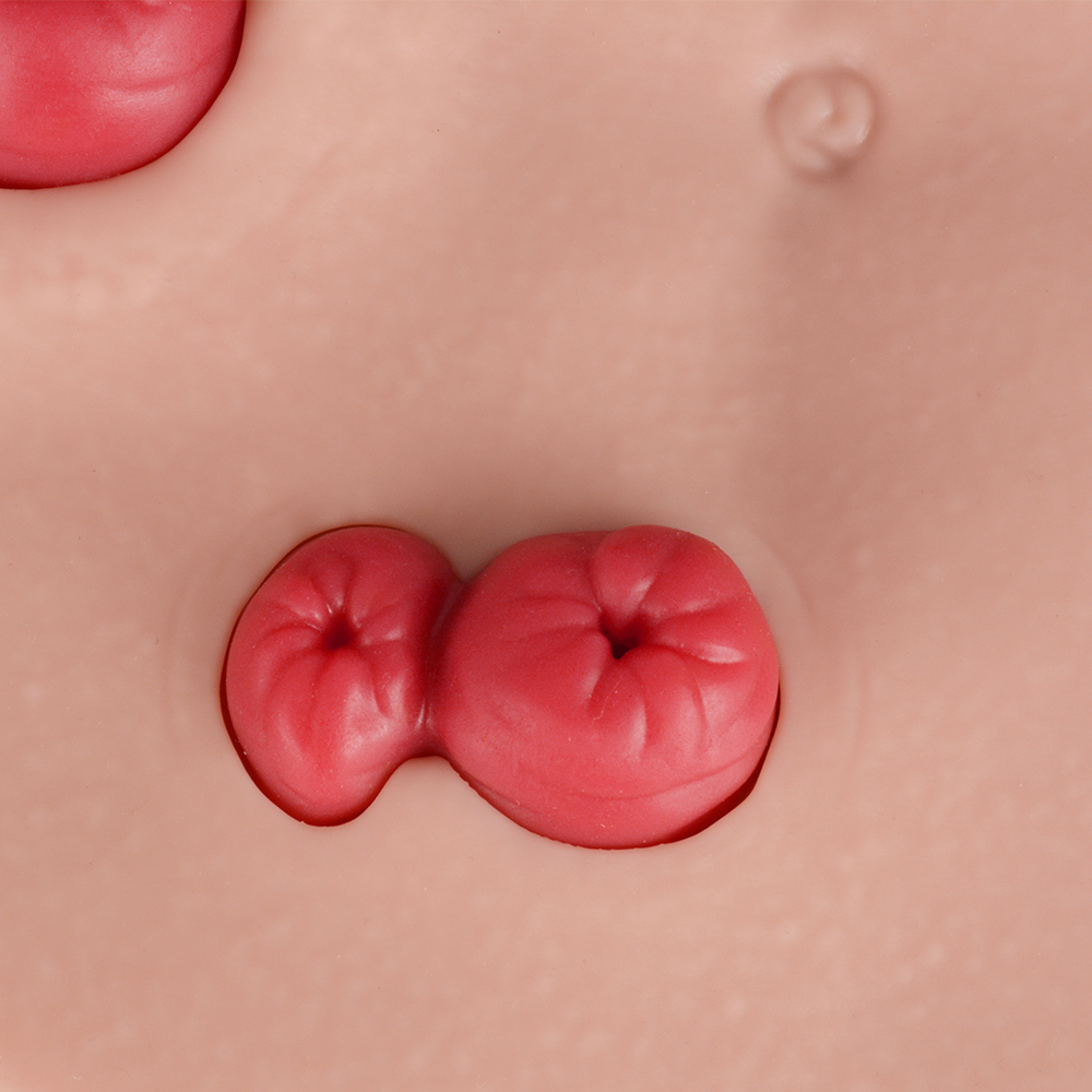 Belly-Worn Wearable Ostomy Care Model