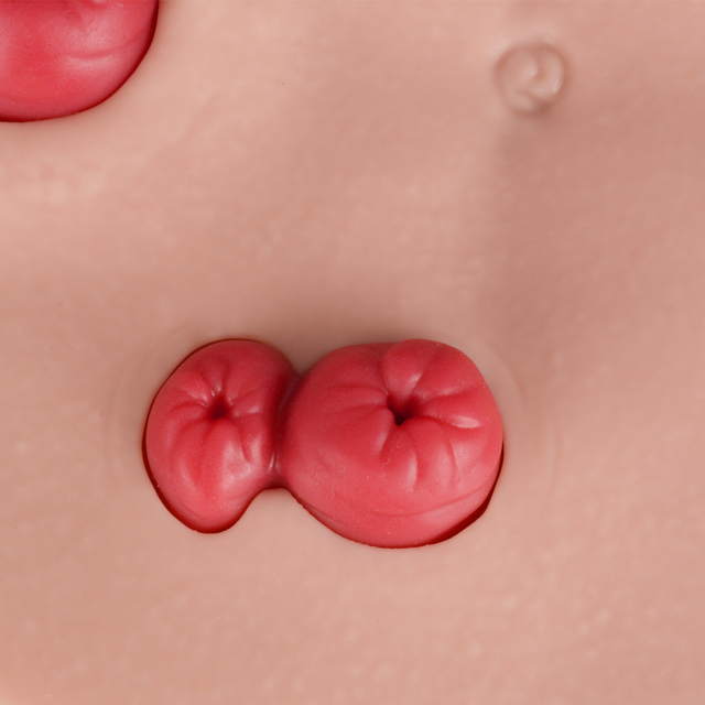 Belly-Worn Wearable Ostomy Care Model