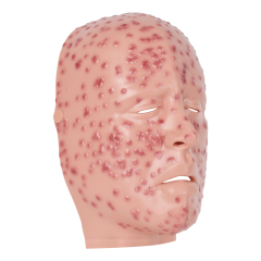 Severe Smallpox Face Training Simulator