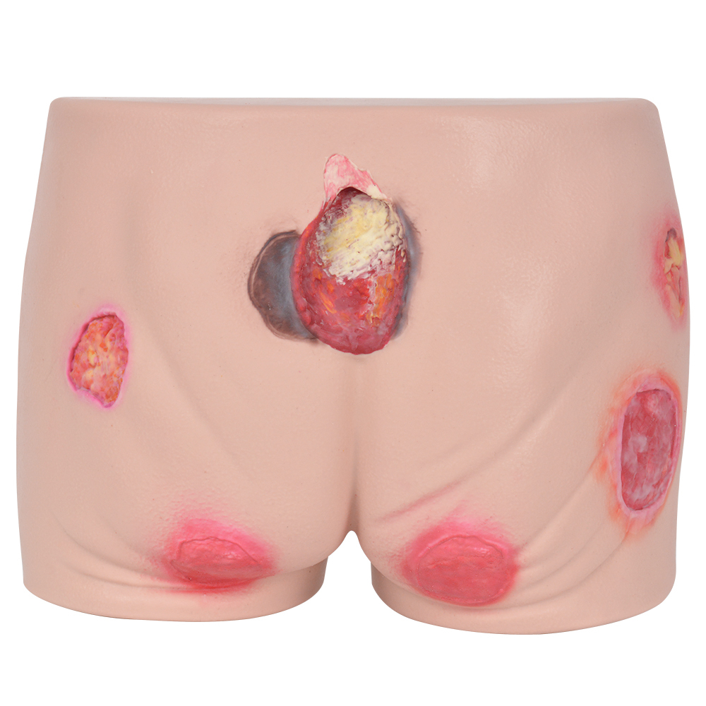 Silicone Pressure Ulcer Simulator