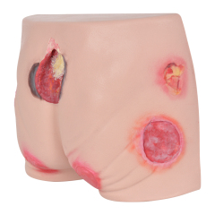 Silicone Pressure Ulcer Simulator