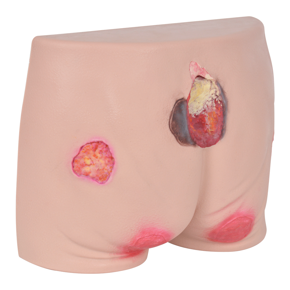 Silicone Pressure Ulcer Simulator