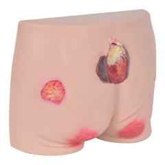 Silicone Pressure Ulcer Simulator