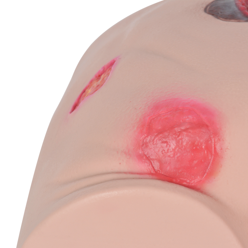 Silicone Pressure Ulcer Simulator