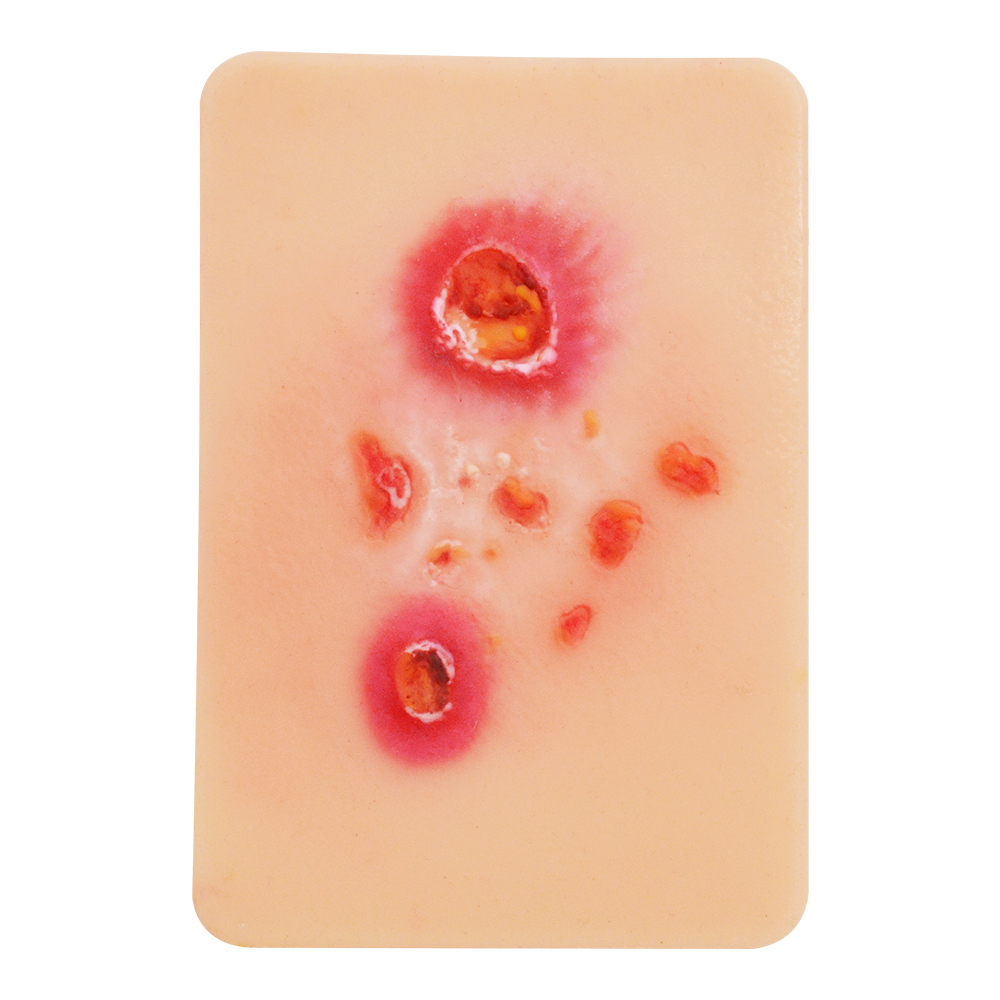 Bacterial Infection Display Cards(4 Types)
